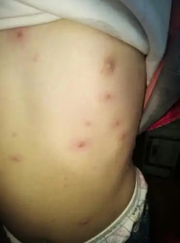 6岁宝宝身上,耳朵里脸上头上起水痘