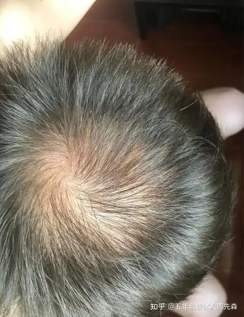 发旋处头发太少了!,我是不是要秃了,怎么办啊! - 知乎