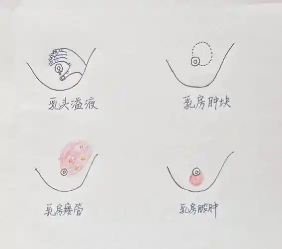 有种"难缠"的乳腺疾病青睐中青年女性_治疗_肿块_乳房