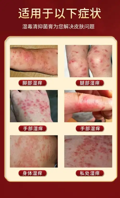 云南本草湿痒膏 抑菌乳膏皮肤外用软膏 水泡过敏闷热湿痒护理膏