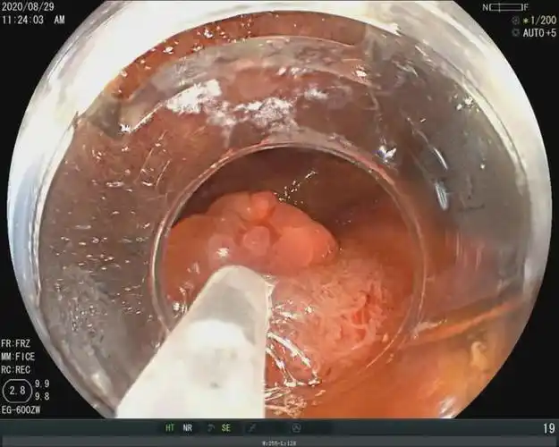 凭祥市人民医院成功施行经脐notes保胆取石及切息肉手术|胆囊|内镜