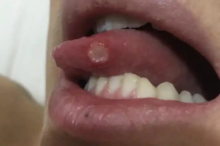 系统性红斑狼疮舌头溃疡图