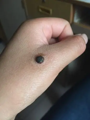 冷冻寻常疣后十三天结疤了,多久能掉呢?掉了以后里面应该是什么样子