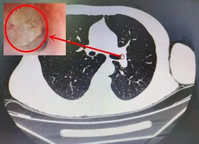 医患用细心谨慎牵出一个早期肺癌病灶