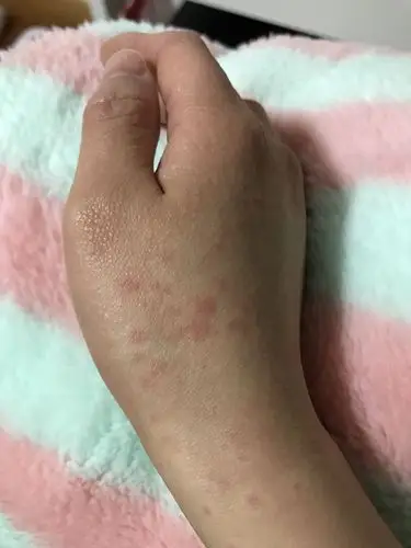 手背上都是一片片红色的疹子 很痒,这是什么,怎么办