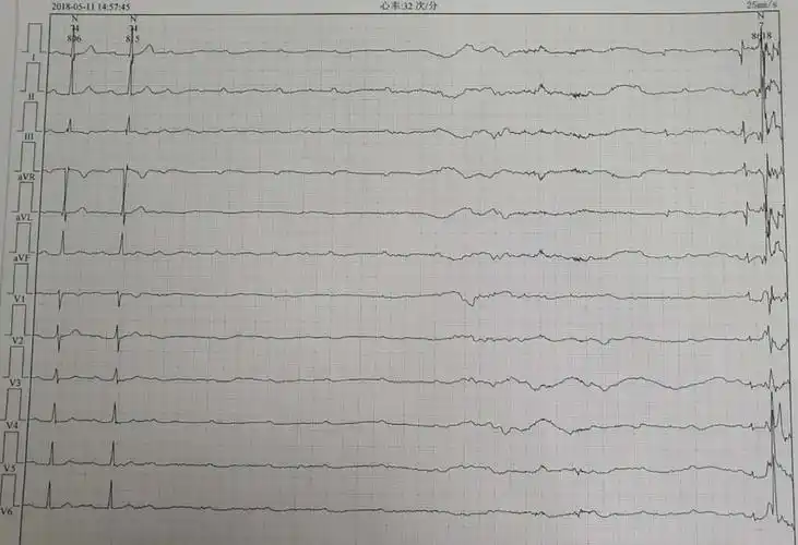 心电图,用心守护您的心脏