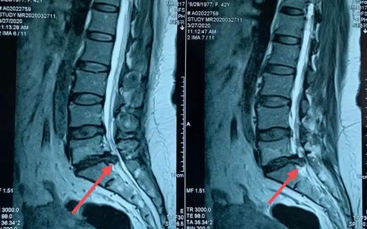 腰间盘突出治疗秘方_腰间椎盘突出注意事项_野杨梅树根可以治腰间突出