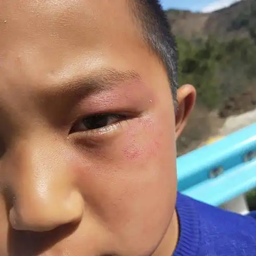 小孩子哭了之后用手揉眼睛周围全是红的