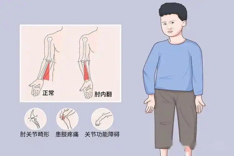 肘外翻/肘内翻畸形的症状部分损伤移位明显的骨折未采用手术治疗仍然