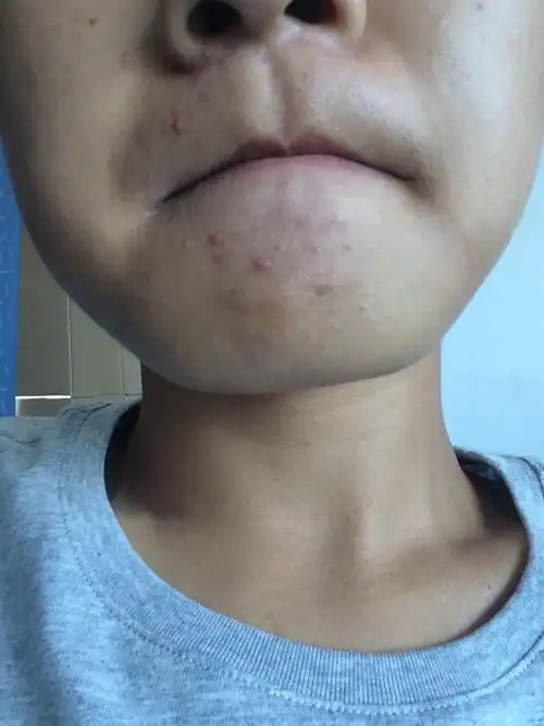 我下巴这是什么 白头老还是粉刺