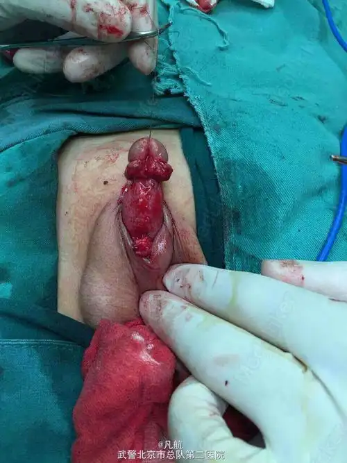 患儿男,6岁,1年前在外院做尿道下裂成形术,但术后患者阴茎明显向下