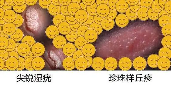 女性菜花状疣早期症状图片,米粒大小的疣体相互融合成菜花状