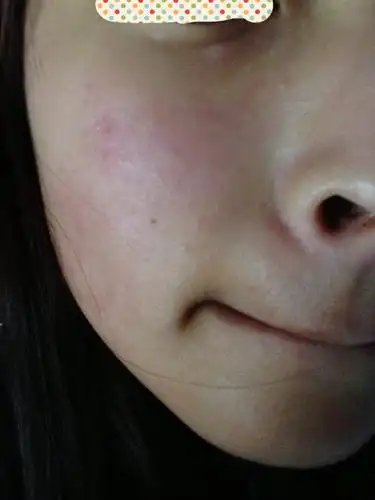 擦化妆品过敏怎么办?我的脸啊