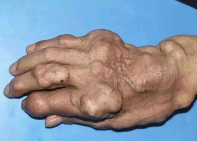 滨州痛风能喝酒吗厂家,价格_痛风能喝酒吗供应,销售-山东温中阳本草生