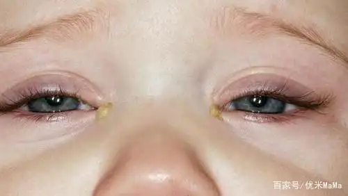 母乳期不忌口导致宝宝结膜炎,祸从口入,三种食物要拉进黑名单