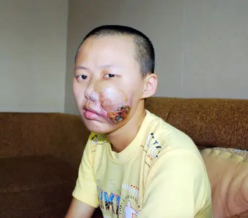 [原创]少女左脸长瘤 终日不敢见人