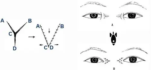 眼整形科普五:内眦赘皮术式解读——y-v成形术-春雨医生