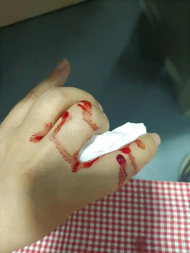 俗话说见血迫灾,希望是个好兆头. 一不小心切到手