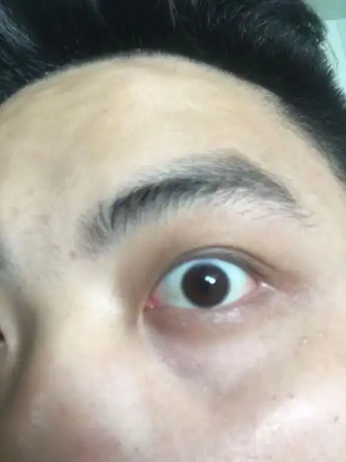 眼睛是黑眼圈还是眼袋