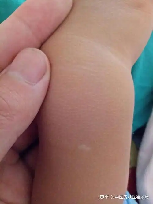 这是白癜风吗还是白色胎记小婴儿也会得白癜风吗