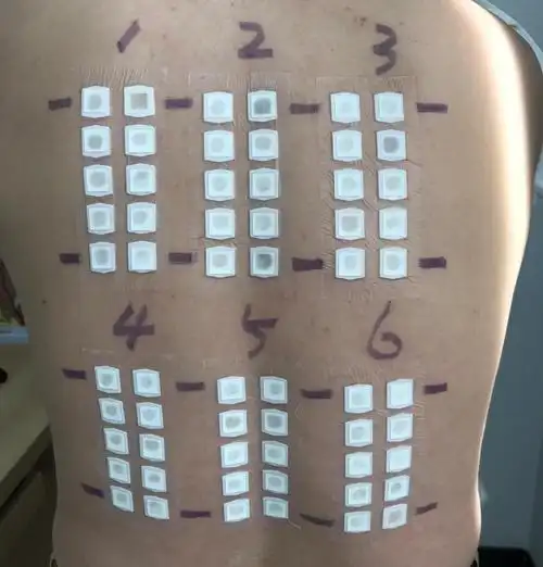 抽血查了食入和吸入性过敏原,同时也做了接触性过敏原也就是斑贴试验