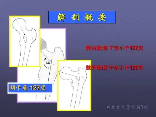 股骨颈骨折 课件 精品ppt