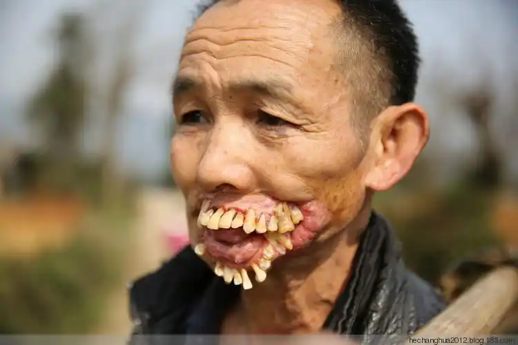 谁能治好他:被狼"舔过"的人