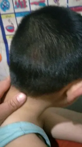 孩子从板凳摔地后脑勺摔了个大包血隐有事没