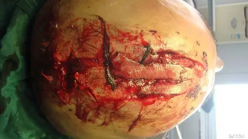 【讨论】头皮斧子砍伤,怎么修复? [病例帖]