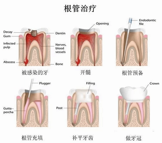 根管不做冠早晚是后患患者不做冠后牙齿劈成了两半