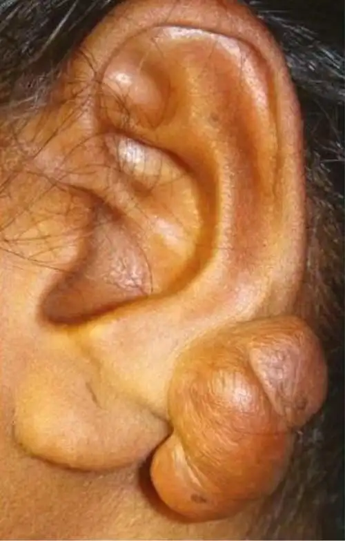 耳朵上的"小烦恼" - 春雨医生