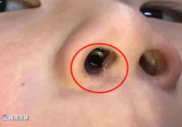 恰巧乐乐在此前又得了一次感冒,妈妈看了看鼻子没什么事,也就以为是