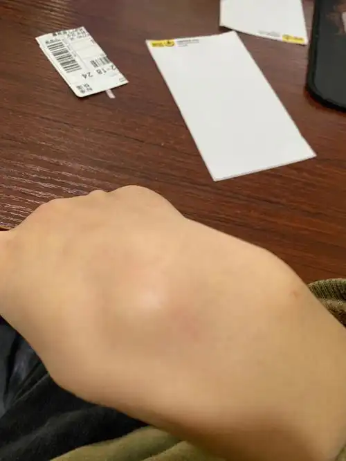 手腕腱鞘囊肿复发了