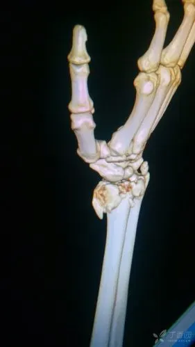 难得一见的桡骨远端骨折 smith骨折 [病例帖]