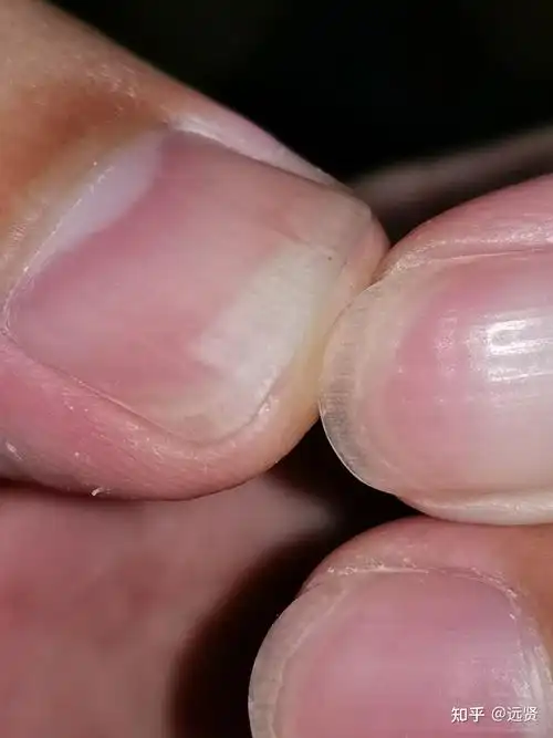 指甲突然有一部分和甲床分离了 不痛不痒为什么?