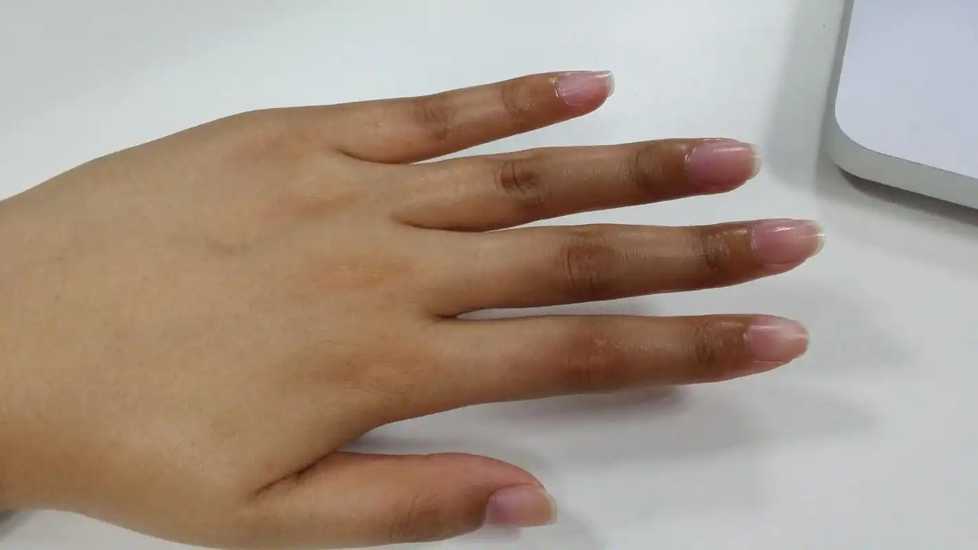 焦虑症(心脏神经官能症)会引起手指关节变黑吗?