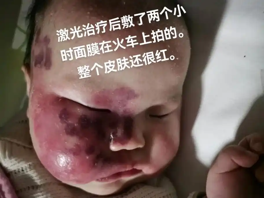 记录鲜红斑痣第二次激光治疗(上海九院).等半年就可以做光动力 - 抖音