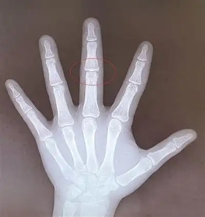 骨骺线已近闭合