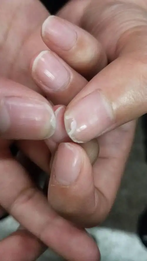 指甲裂了怎么回