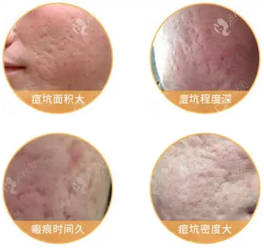 颜值再高难敌坑洼难堪,对号入座痘坑类型1冰锥型痘坑:痘坑开口小,约