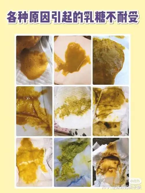 宝宝乳糖不耐受腹泻,过敏性腹泻,感染性腹泻的便便图谱和应对措施