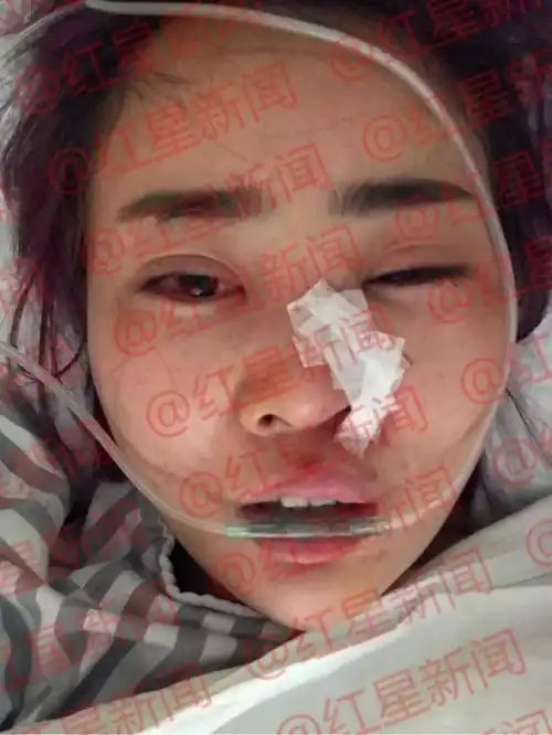 毁容女孩公开近照律师张口就要30万我出不起