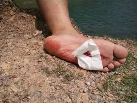 梦见脚被扎破流血