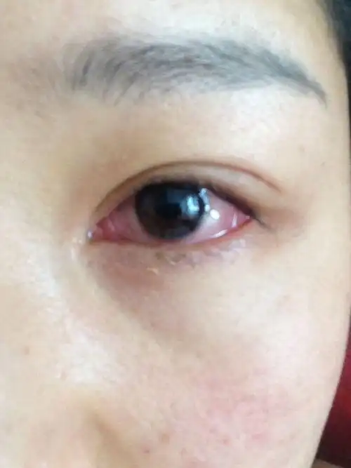 眼睛特别红,医院检查说是急性结膜炎,可是开了眼药水用了两天都不见好