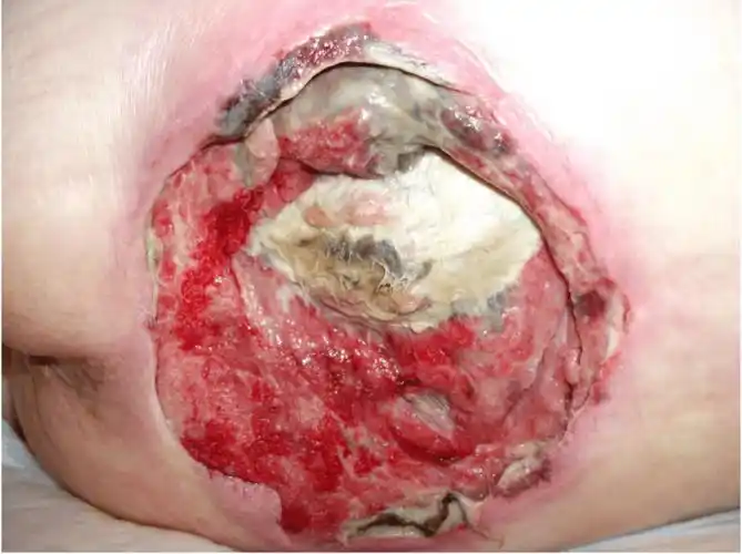 初次评估3周后和使用appeel无菌粘胶清除剂1周后,伤口周围皮肤完整