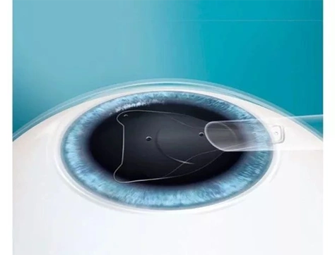 作为拯救高度近视的"法宝",icl晶体植入术的优点可不止于此……