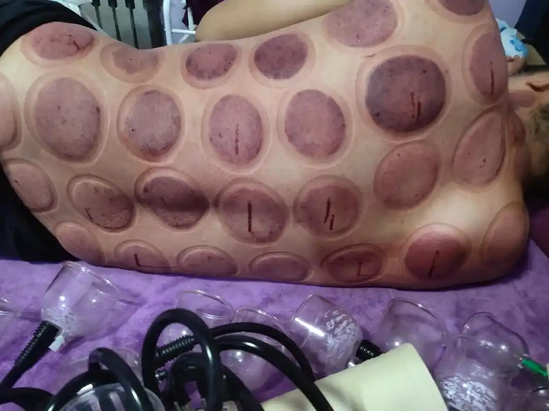 这是一个30岁小伙拔罐的图片,一朵花的年龄就失眠浑身难受,一 - 抖音