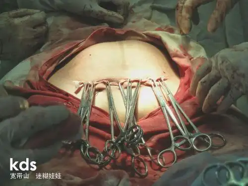 顺产破腹产全过程,男人们请珍惜为你生孩子的那个女人