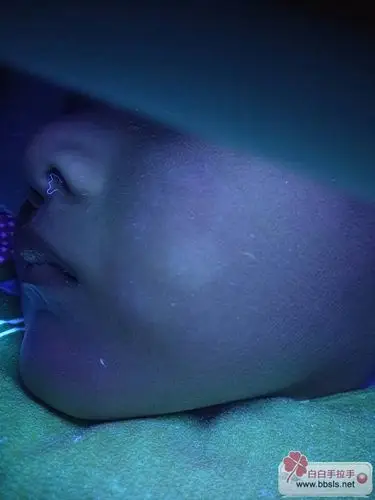 请博士帮忙看看,这是白色糠疹还是白白?