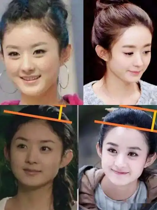 聊聊当红小花旦赵丽颖的变美之路打了瘦脸针面部吸脂